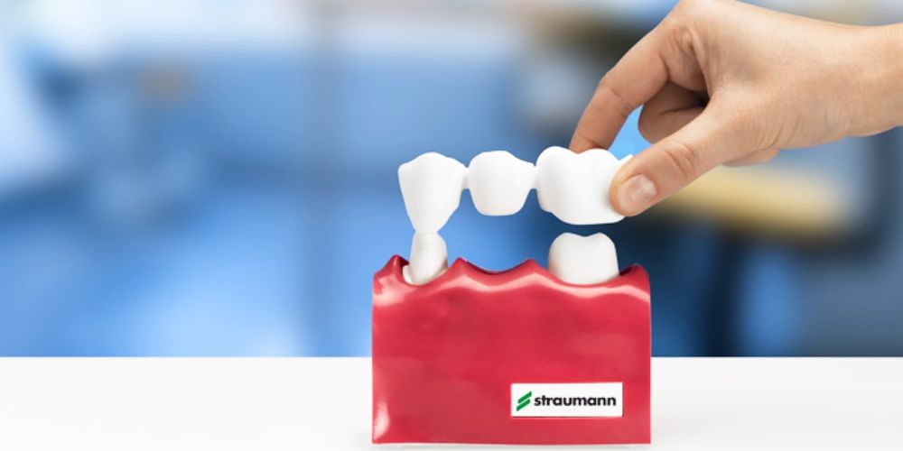 Estetsko zobozdravstvo: Mostiček ali zobni implantat?