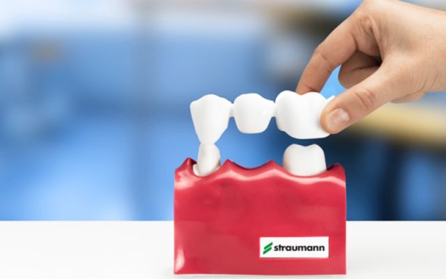 Estetsko zobozdravstvo: Mostiček ali zobni implantat?
