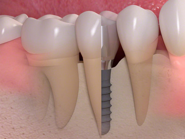 Prednosti zobnih vsadkov
